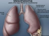 Malagnant Mesothelioma