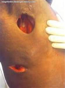 Emergency Room For Staph Emergency Room For Staph
