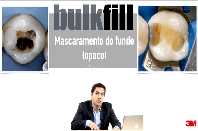 DENTÍSTICA: Restauração posterior de passo único utilizando a resina Bulk Fill - 3M Brasil