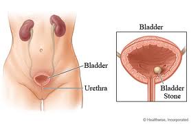 forum symptome cancer de la prostate como se hace una biopsia de prostata