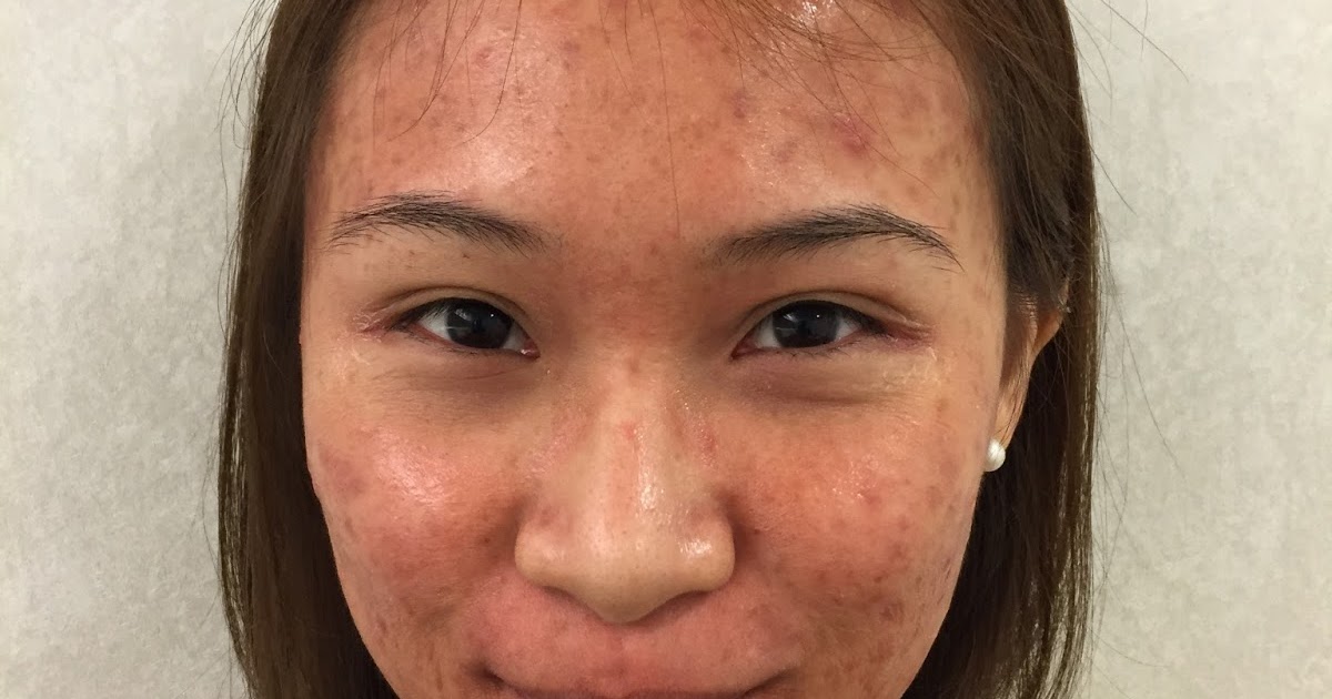 Dr Gerard Ee Clifford AGNES and Qswitch laser. The treatment for