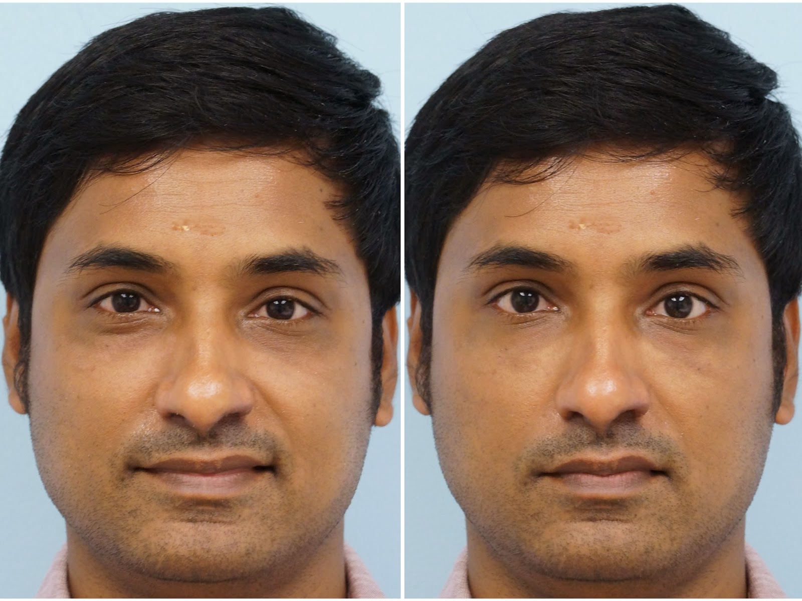 Изменение формы глаза. Изменение цвета глаз до и после. Операция по изменению цвета глаз. Пластическая операция увеличение глаз.