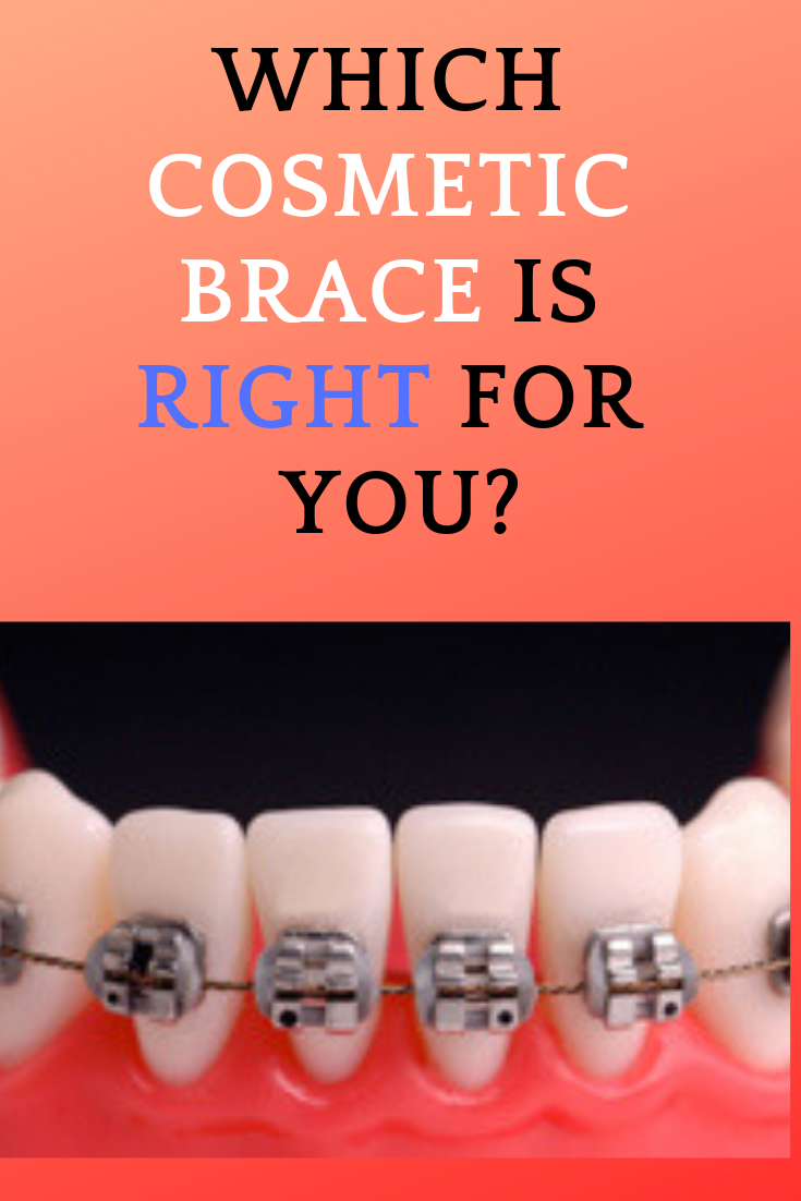 Which Cosmetic Brace is Right for You?
