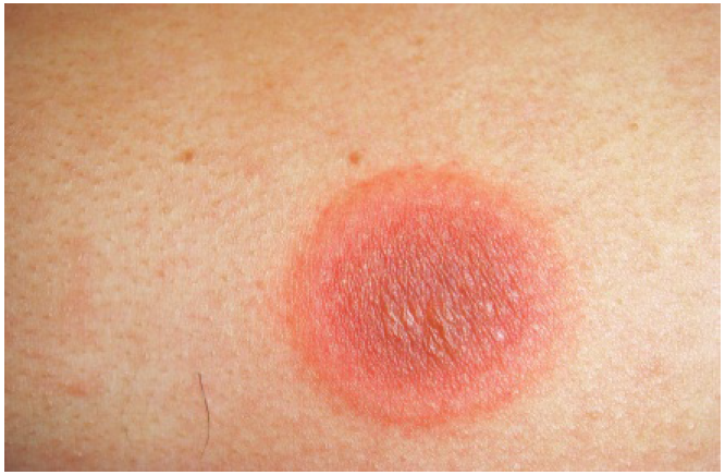 144 PENYAKIT: FIX DRUG ERUPTION (FDE)/ERUPSI KARENA OBAT