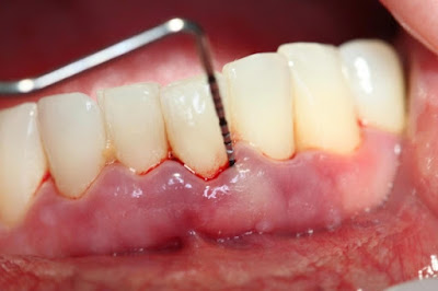  Điều trị viêm chân răng như thế nào? 