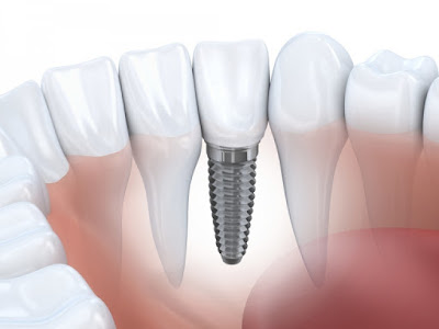 Cấy ghép Implant thực sự phù hợp cho người mất răng