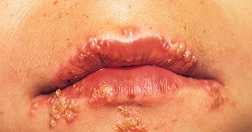 Mengatasi Herpes Yang Muncul Pada Bibir Dan Genital Dengan Cara Mudah