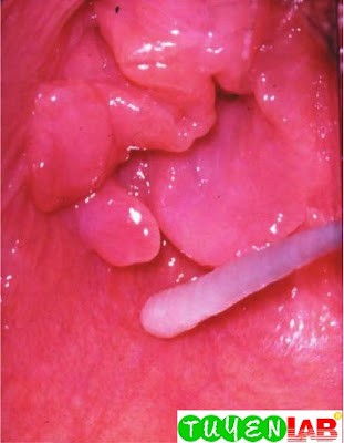 Hymenal cleft visible when the girl in Figure 1 is more carefully examined using a saline moistened cotton-tip applicator to gently separate and demonstrate the edges of the hymen Hymenal cleft visible when the girl in Figure 1 is more carefully examined using a saline moistened cotton-tip applicator to gently separate and demonstrate the edges of the hymen