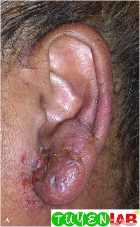 Pediatric Atlas Of Otitis Externa Free Medical Atlas
