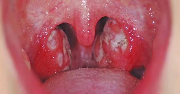 Please Read This Before You Delete It! The Cure Of The Throat Infection