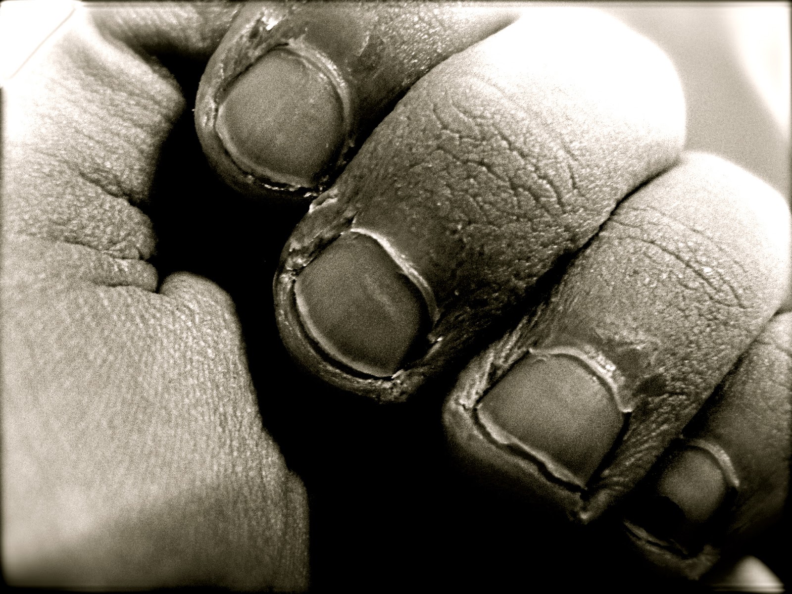 El tratamiento del hongo de las uñas en los pies de la gota
