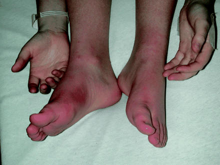 Parathesia In Feet 3