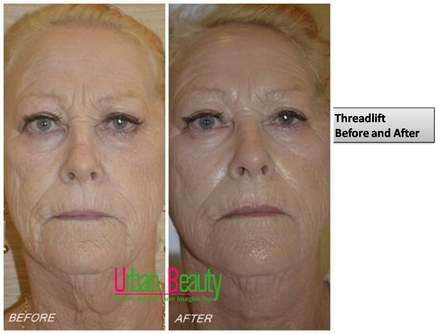 Best Promo Thread Lift Thailand Urban Beauty Thailand Before and After Gallery