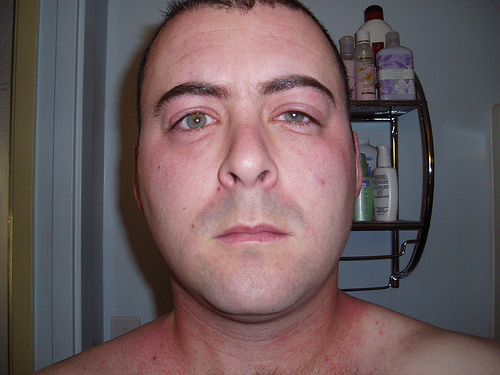 Gallery For Allergic Reaction On Face Swelling