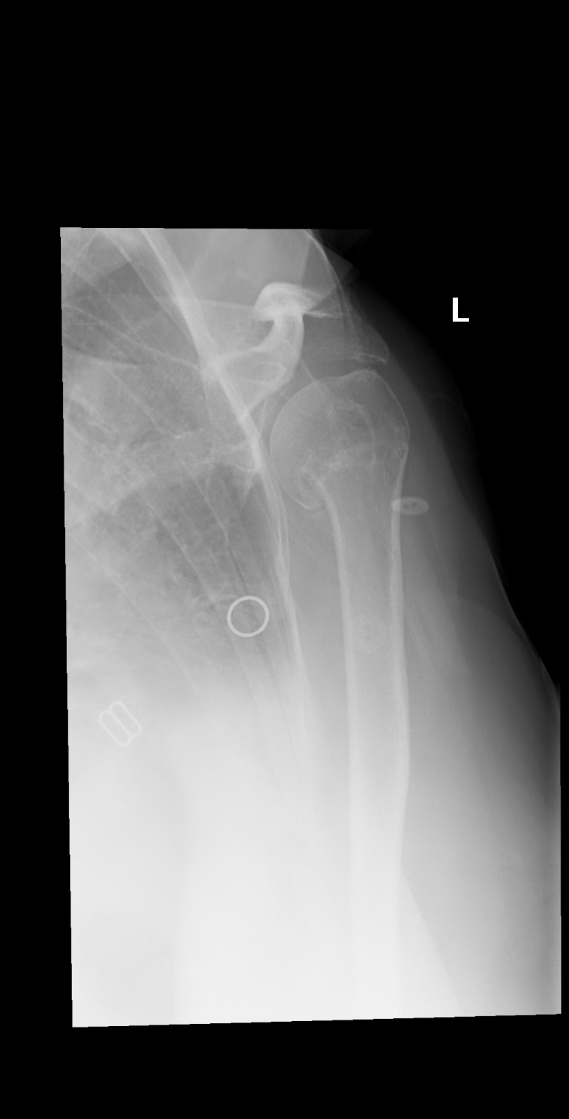 Shoulder and Elbow Surgery Shoulder subluxation after proximal humerus