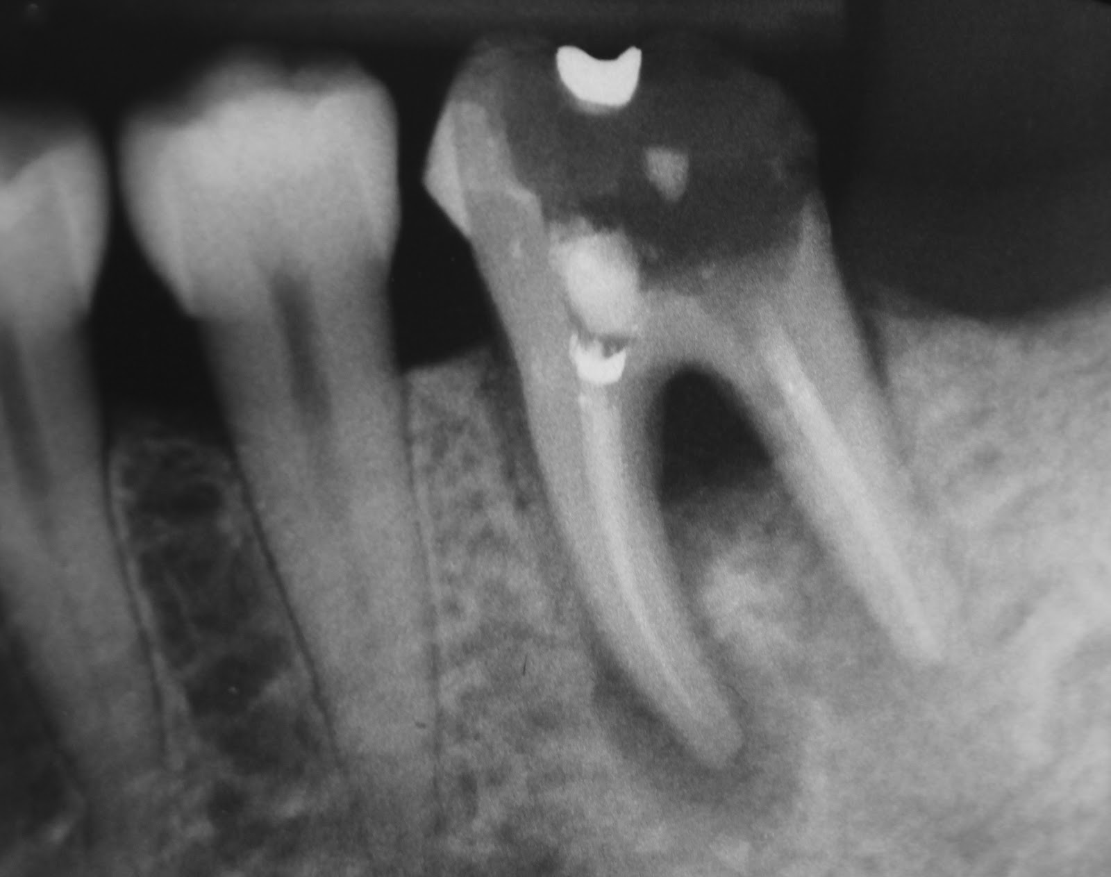 Ask DrM How far do we go to save a tooth?