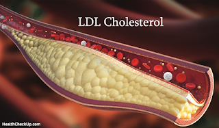 Definisi & Pengertian Kolesterol Jahat ( LDL )