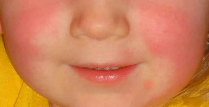 How does scarlet fever affect children