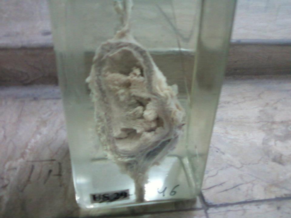 Medical Education for Students Gross Specimens General Pathology (50