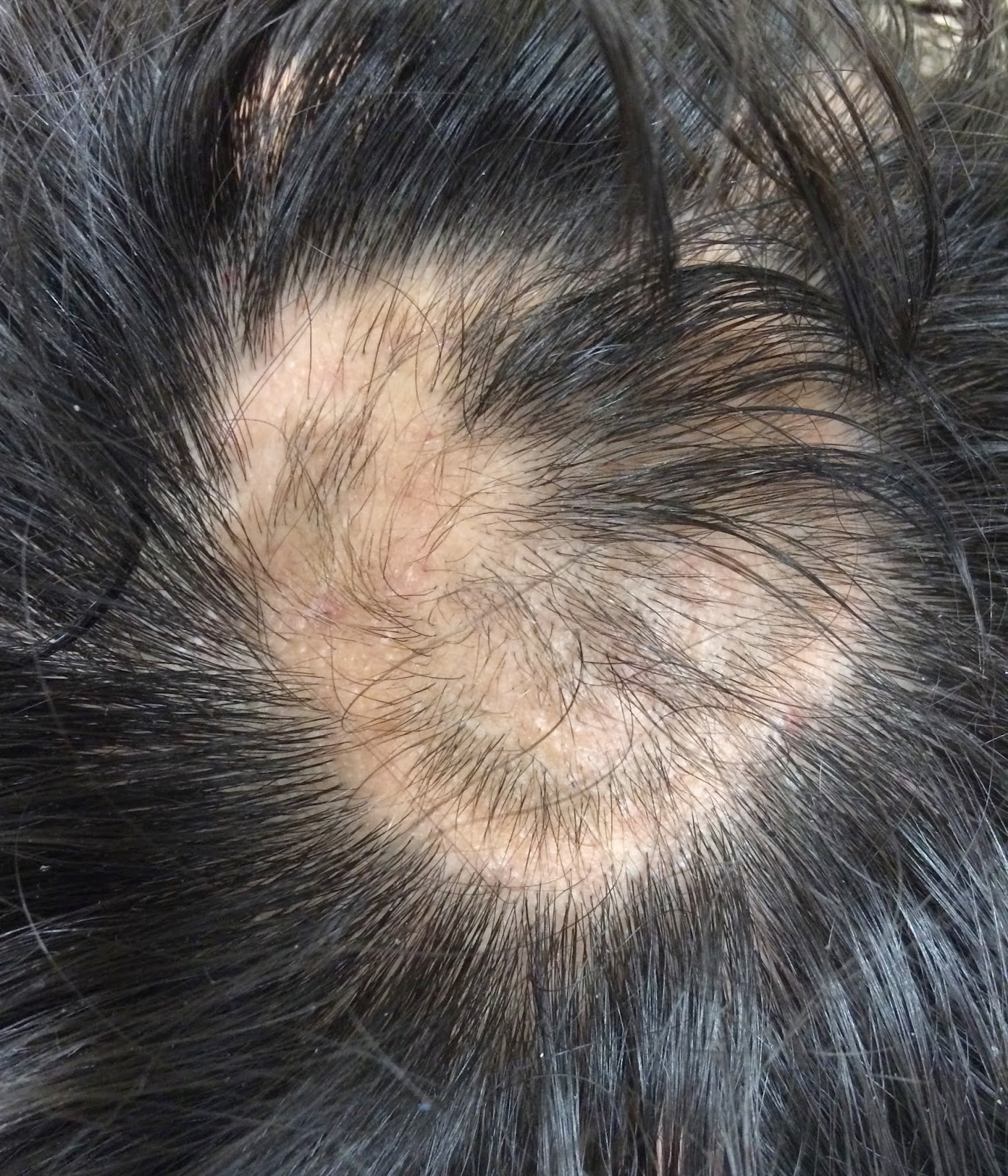alopecia-areata-up-to-date-wiletutor
