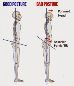 6 Bad Postures That Are Ruining Your Health & How To Correct Them - Anterior Pelvic Tilt