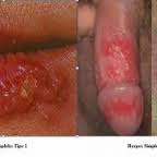 Durasi Wabah Penyakit Herpes Oral
