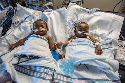 1a Beautiful new photo of former conjoined Nigerian twins, Miracle and Testimony Ayeni (Photos)