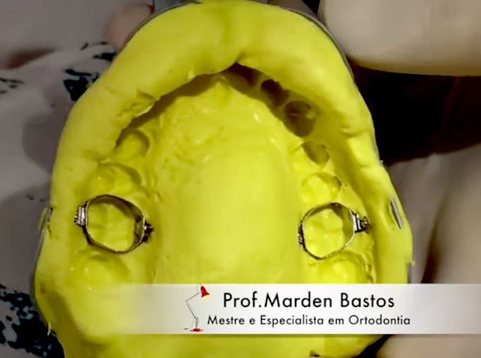 MOLDAGEM DE TRANSFERÊNCIA : Dica de Ortodontia - Dr. Marden Bastos