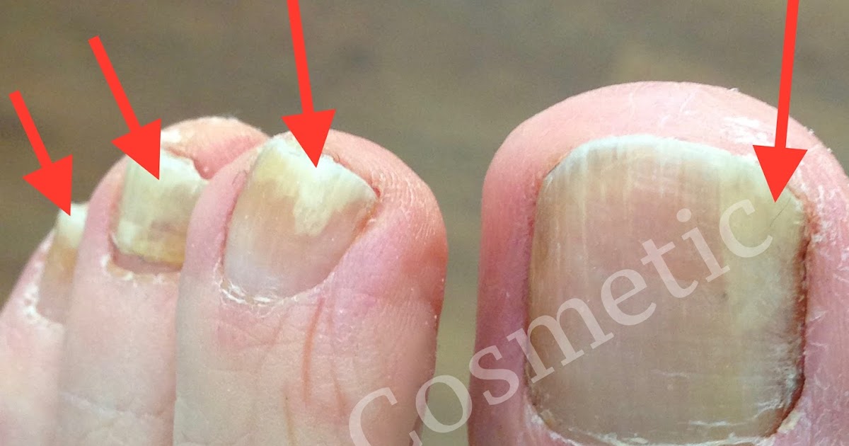 Fußnagel löst sich ab. Jenn Cosmetic. Nagelpilz strapaziert unsere Fußnägel. Was hilft? Das Fußnagel löst sich ab. Jenn Cosmetic. Nagelpilz strapaziert unsere Fußnägel. Was hilft? Das