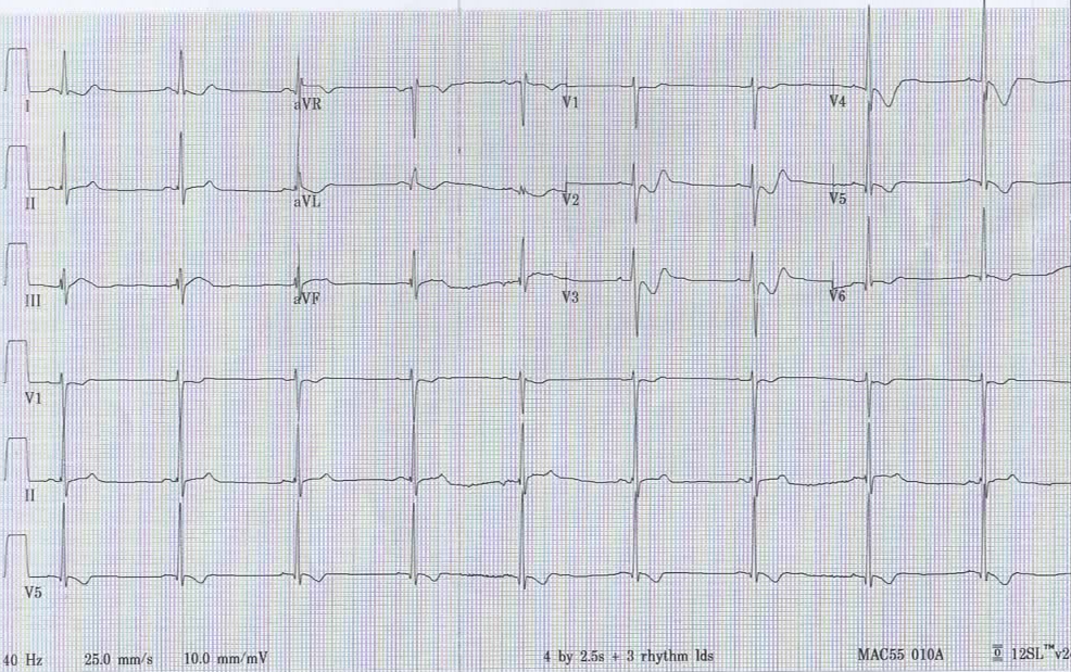 EM CaseLink Jiu Jitsu 1, Myocardium 0. Chest Pain After Jiu Jitsu