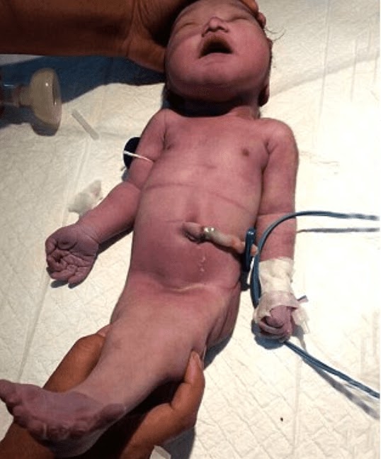 The Heartbreaking Story Of The 'Mermaid Baby' That Shocked The World