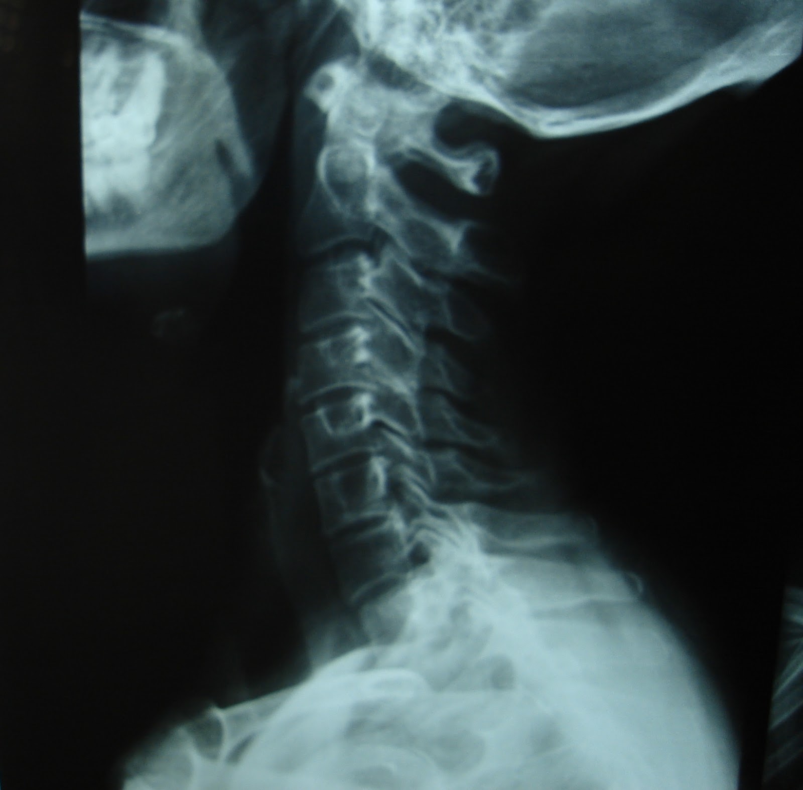 Rectificación cervical