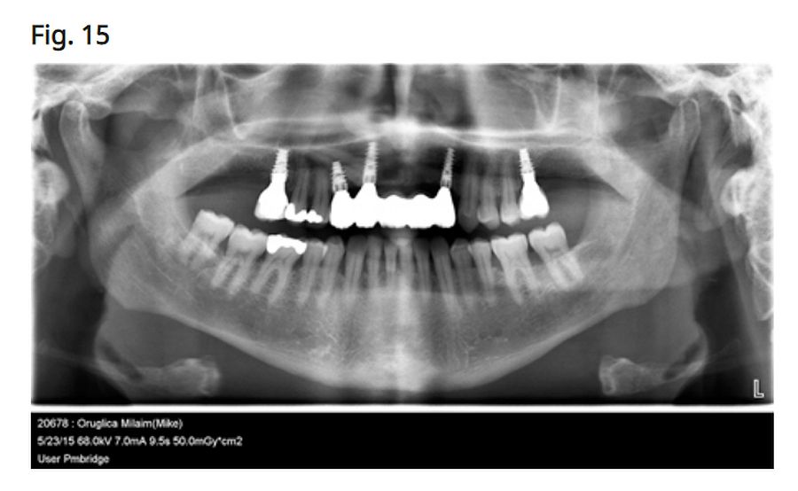 IMPLANTOLOGY Unconventional Implant Placement Through An Impacted