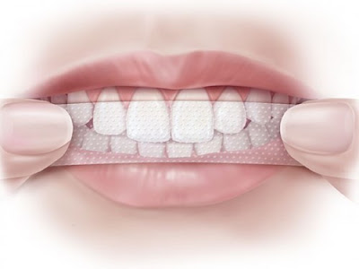 Miếng dán trắng răng có hại không?