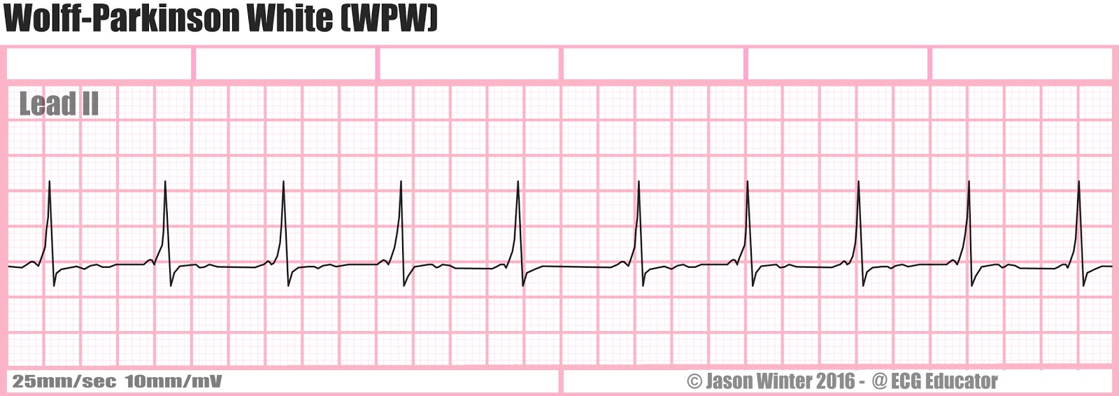 ECG Educator Blog WolffParkinsonWhite ECG Educator Blog WolffParkinsonWhite