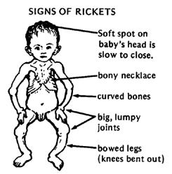 [brief history of rickets and of the discovery of vitamin d].