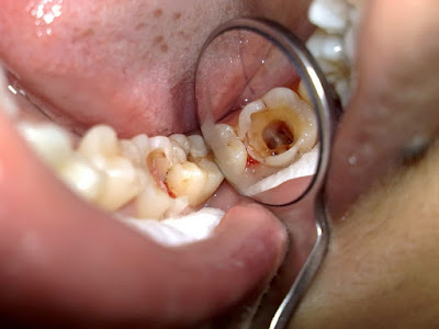 Quy trình trám răng tại nha khoa
