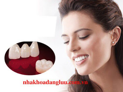 Tìm hiểu bọc răng sứ cho răng hàm