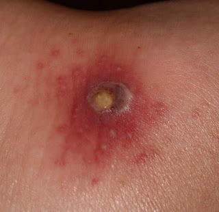 How to Treat an Infected Blister: 13 Steps (with Pictures)