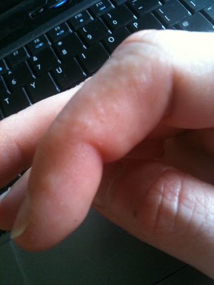 itchy rash on fingers #11