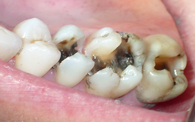 Răng sâu có cần phải bọc sứ không?
