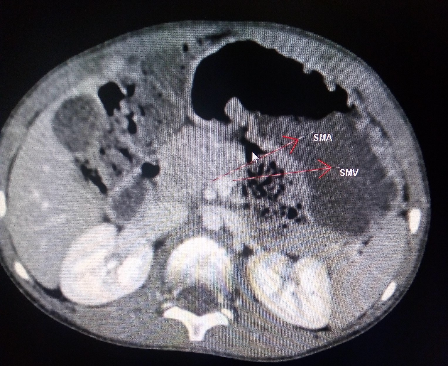 Midgut Volvulus CT Sumer's Radiology Blog