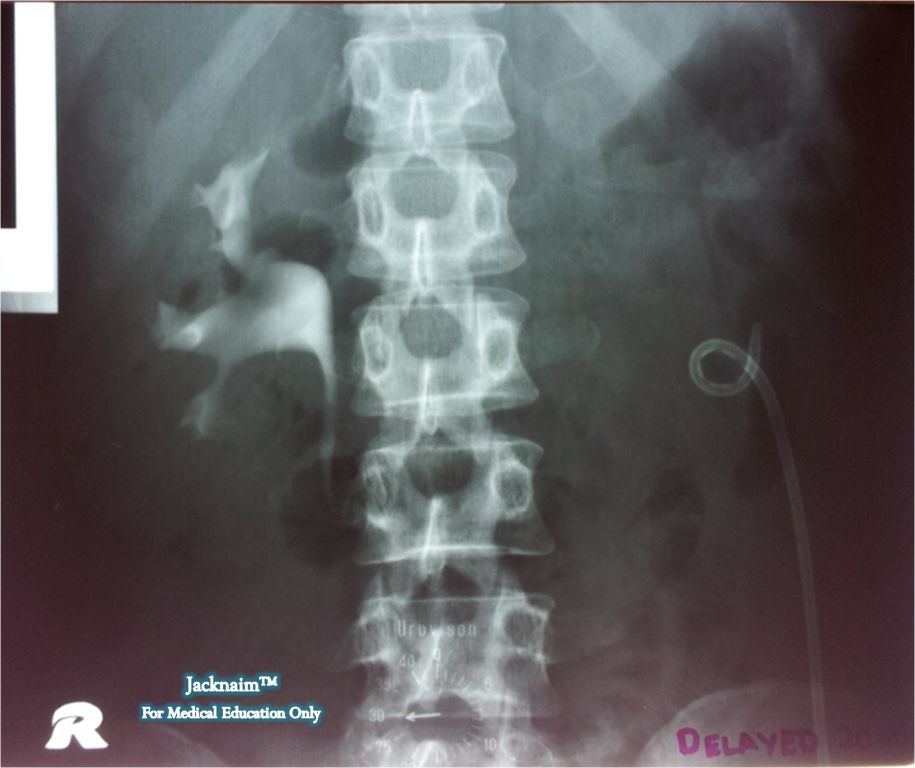 My Medical Notes Intravenous Urogram Non Functioning Left Kidney