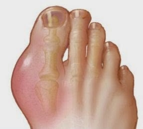 Image result for jari jempol kaki bengkak