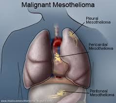 Mesothelioma. What Exactly Is ?
