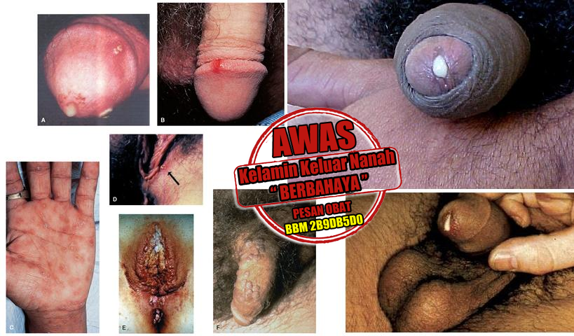 Tips Cara Mengobati Kencing Nanah Secara Alami Yang Ampuh Tips Cara Mengobati Kencing Nanah Secara Alami Yang Ampuh