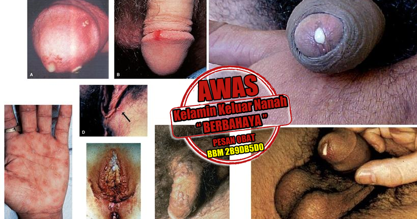 Std symptoms pictures in teens, indo artis xxx