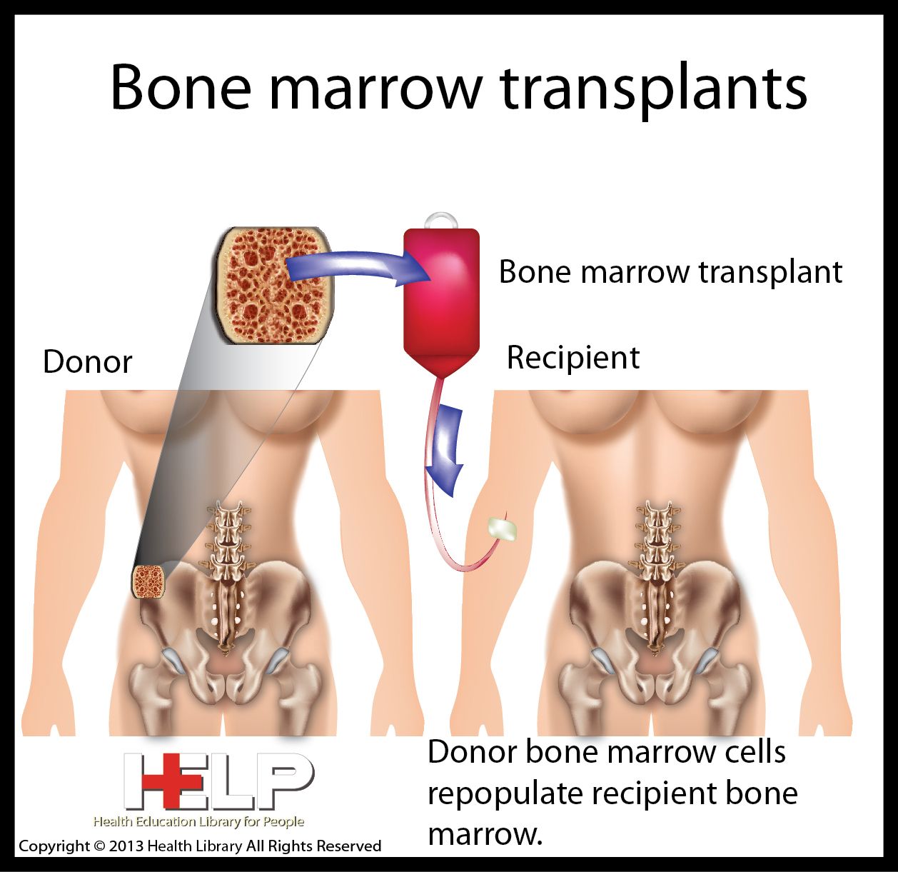 Пересадка при лейкозе. Трансплантация костного мозга. Трансплантация костного мозга алгоритм. Трансплантация гемопоэтических стволовых клеток стволовые клетки.