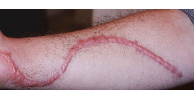 hipertrofik skar nedir keloid nedir