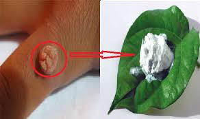 Image Menghilangkan Kutil Kelamin Herbal Alami